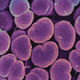 Doctors have been waiting for cases of highly resistant gonorrhea, caused by the bacterium Neisseria gonorrhoeae, above, to show up. Now one definitely has.